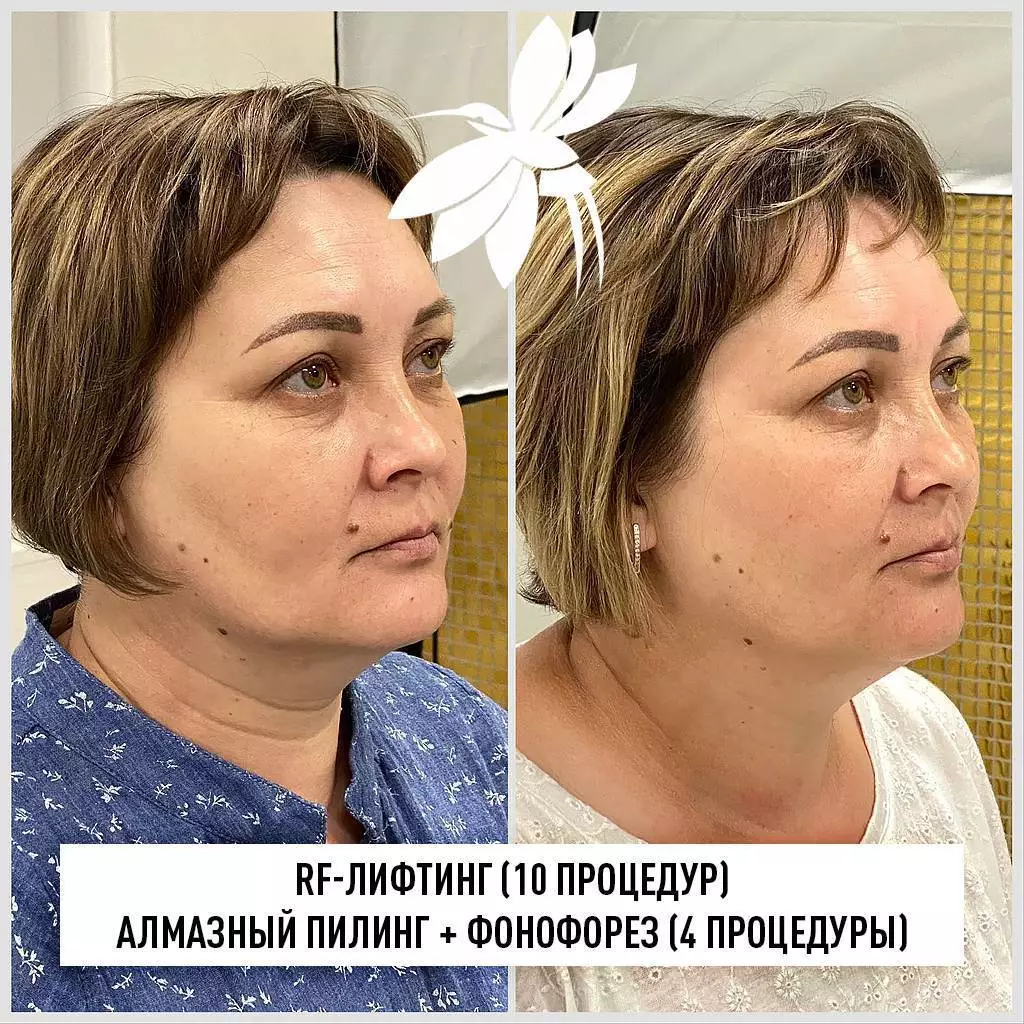 Протокол процедуры «Фарфоровая куколка»: как сочетать фонофорез с другими методиками для максимального эффекта Протокол процедуры «Фарфоровая куколка»: как сочетать фонофорез с другими методиками для максимального эффекта
